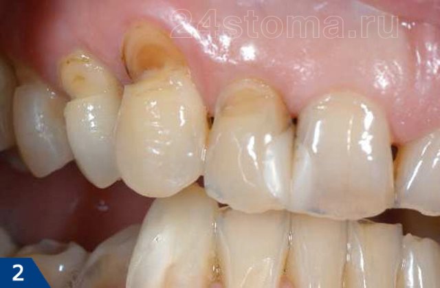 Клиновидный эффект на зубах